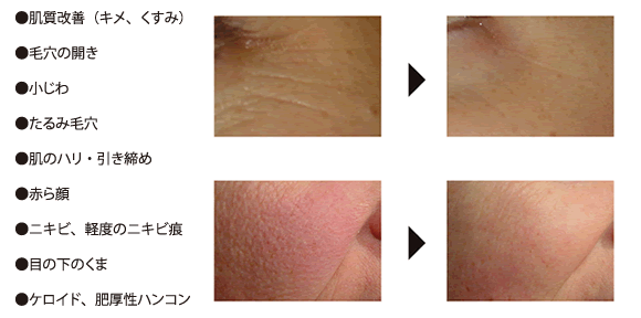 肌質改善など様々な症状に効果が期待できるジェネシス治療器