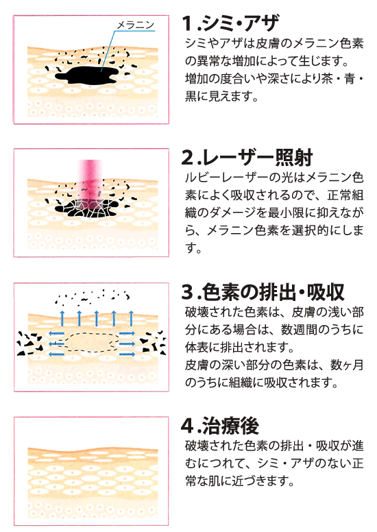 ルビーレーザーの治療のメカニズム